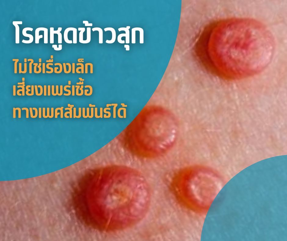 โรคหูดข้าวสุก ไม่ใช่เรื่องเล็ก เสี่ยงแพร่เชื้อทางเพศสัมพันธ์ได้